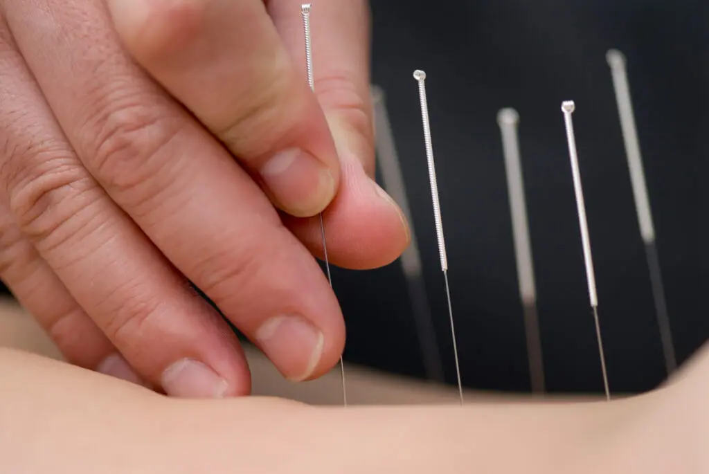Treatment by acupuncture. The doctor uses needles for treatment of the patient.