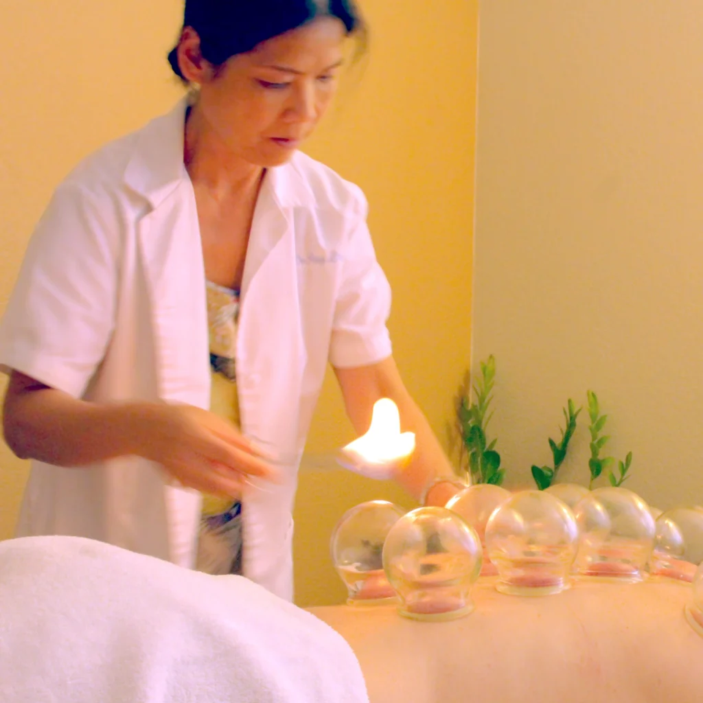Dr. Liu performing a cupping treatment