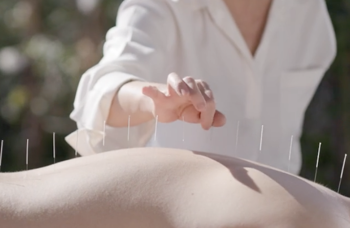 Acupunture being done on someone's back