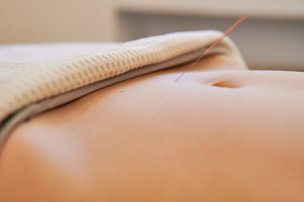 Acupuncture for Infertility